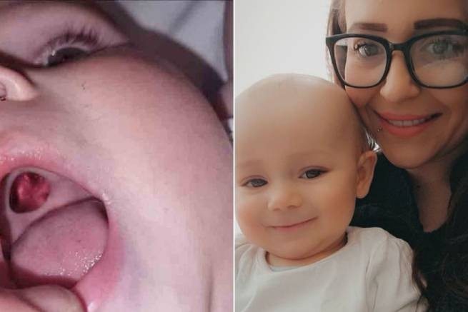 Великобритания: мать обнаружила дыру во рту малютки