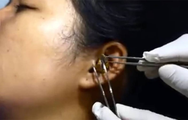 Жуть: хирург пытался удалить живую змею из уха женщины