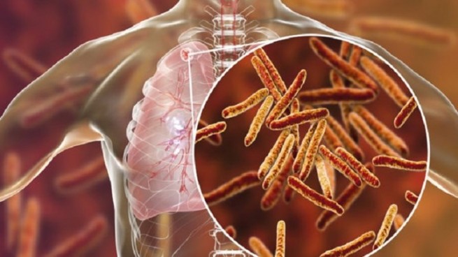 24 марта - международный День борьбы с туберкулезом