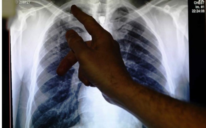 Эксперты предупреждают об эпидемии туберкулеза в Греции среди мигрантов