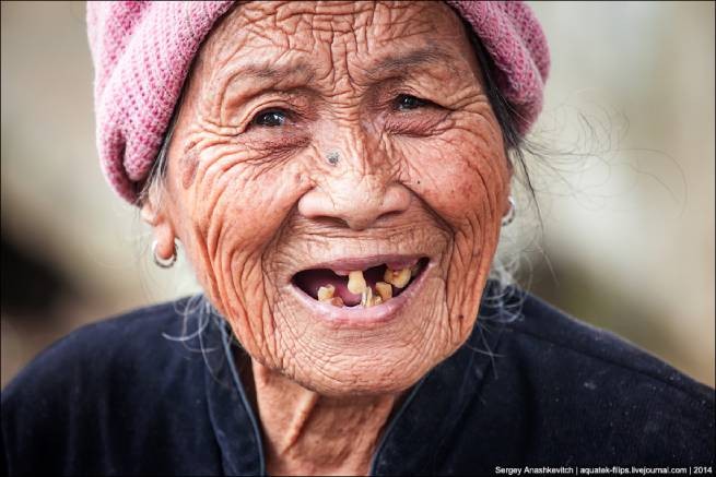Потеря зубов и деменция - есть ли связь