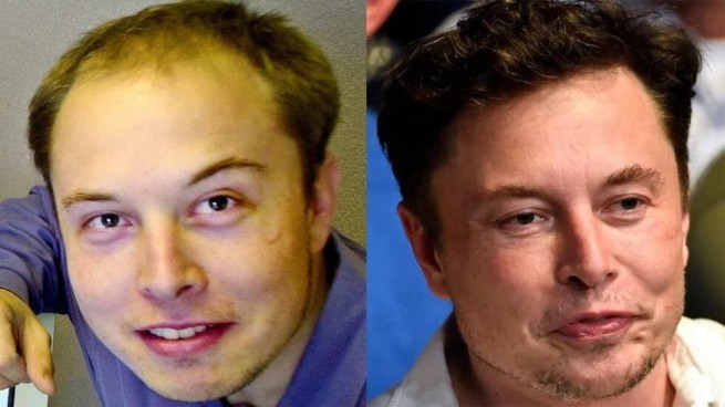 Илон Маск потратил 172 тысячи долларов на пластическую операцию и пересадку волос: фото до и после