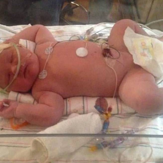 Израиль: у новорожденной девочки в животе оказался... эмбрион