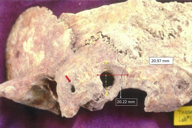 Найден череп со следами трепанации IV века нашей эры