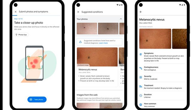 Dermatology Assist: новый умный инструмент от Google