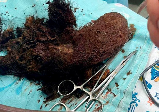 Синдром Рапунцель: врачи в Греции удалили из живота девочки огромный комок волос